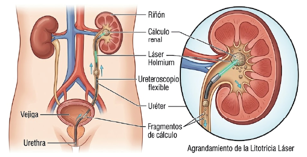 Cirugía Láser para Cálculos