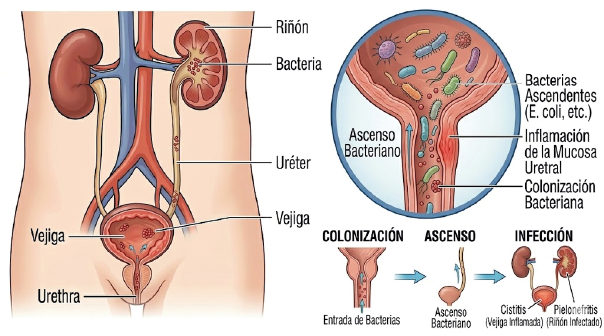 infecciones urinarias cistitis