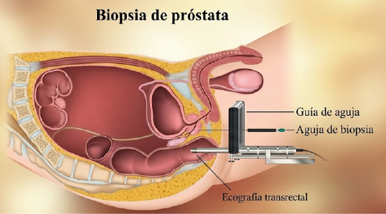 biopsia de prostata