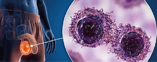 Cistoscopia Transuretral